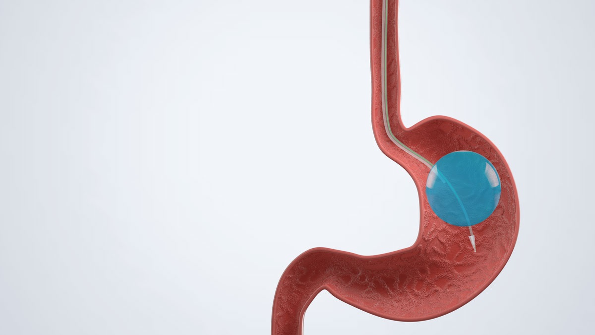 Stella Intragastric Balloon